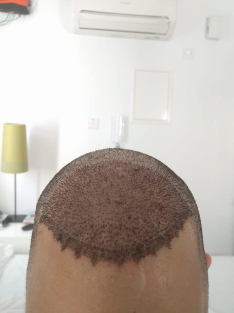 היום השני לאחר השתלת השיער