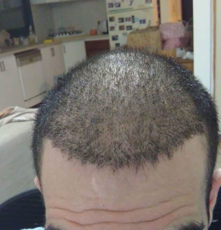 3 שבועות לאחר ההשתלה בקפריסין