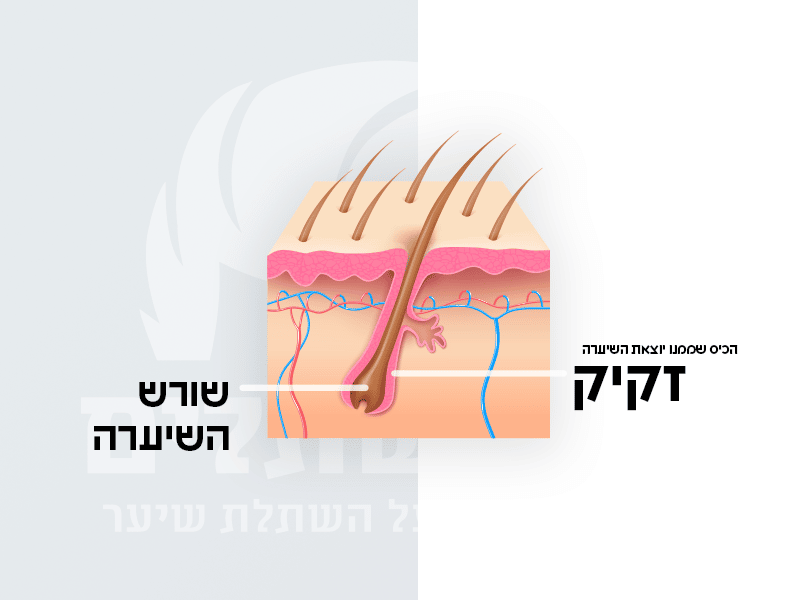 זקיק השיערה