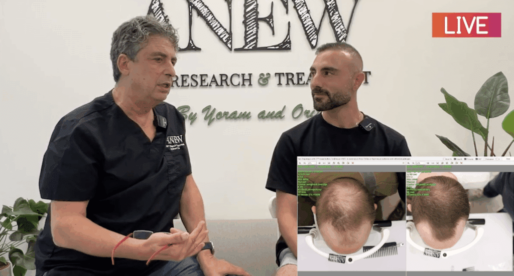 האם טיפולי שיער באמת יכולים לעזור? יורם בניטה מציג תוצאות לפני ואחרי