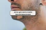 אלופציה אראטה בזקן